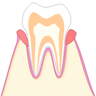 あさみ歯科クリニック｜歯周病