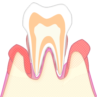 あさみ歯科クリニック｜歯周病
