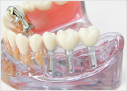 インプラント（人口歯根）|あさみ歯科クリニック
