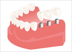インプラント治療|あさみ歯科クリニック