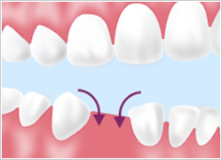 根管治療|あさみ歯科クリニック
