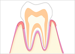 歯肉炎|あさみ歯科クリニック