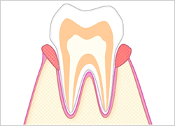 軽度の歯周病|あさみ歯科クリニック
